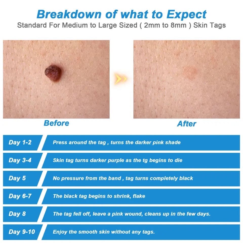 Skin Tag Remover, 2 In1 Painless Auto Skin Tag Remover, Mole Wart Removal Kit, Micro Skin Tag Remover Skin Tag Remover, 2 In1 Painless Auto Skin Tag Remover, Mole Wart Removal Kit, Micro Skin Tag Remover